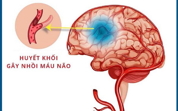 Ai có nguy cơ đột quỵ nhồi máu não?