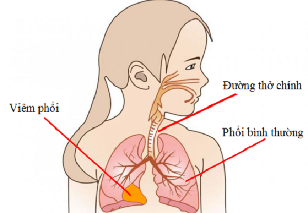Viêm phổi ở trẻ có triệu chứng gì?- Ảnh 2.