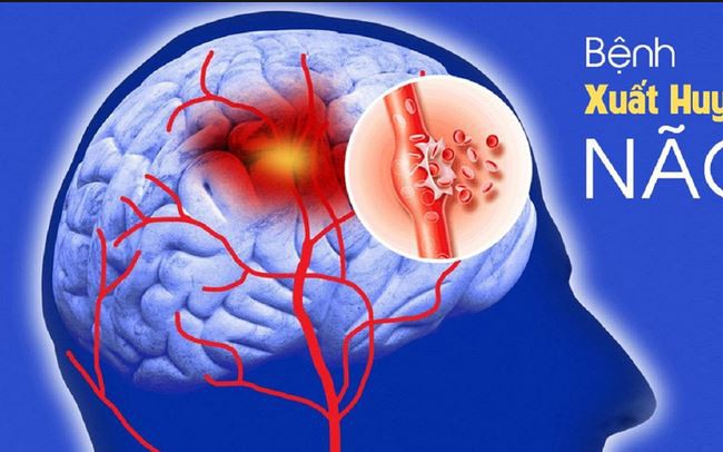 Xuất huyết não nguy hiểm như thế nào?