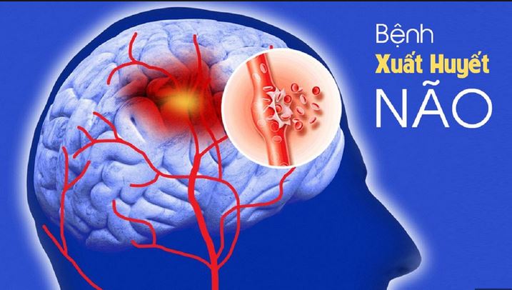 Xuất huyết não nguy hiểm như thế nào?- Ảnh 1.