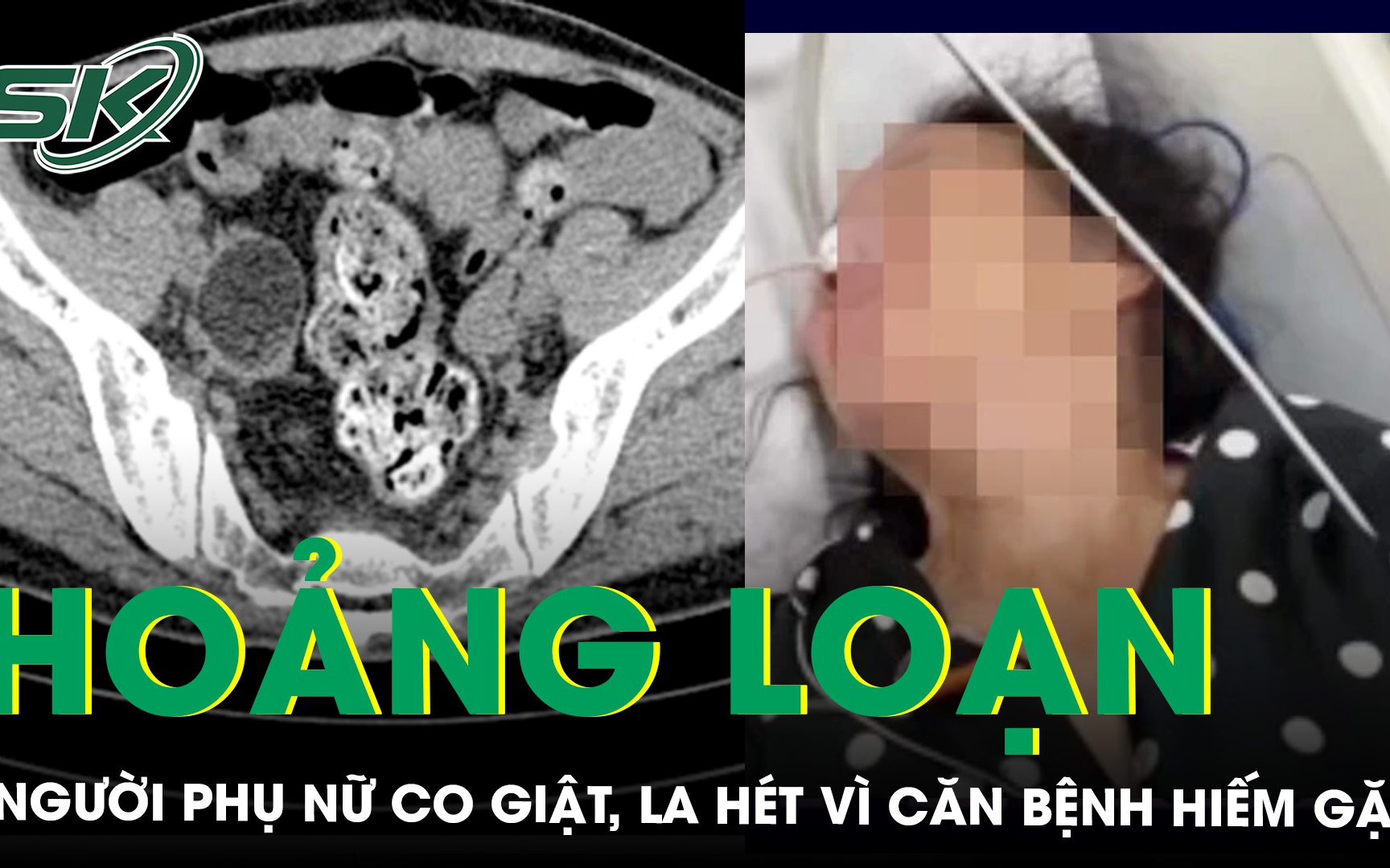 Hoảng loạn, hay la hét, người phụ nữ được phát hiện mắc bệnh lý viêm não tự miễn hiếm gặp