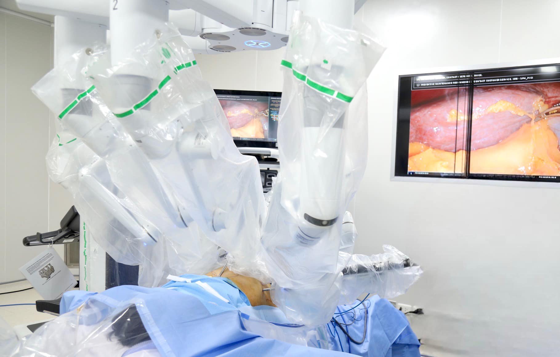 Đưa robot vào phẫu thuật nội soi cắt trọn khối ung thư gan tại Bệnh viện K- Ảnh 3.