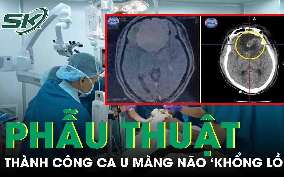 Đau đầu, chóng mặt, vào viện phát hiện khối u màng não 'khổng lồ'