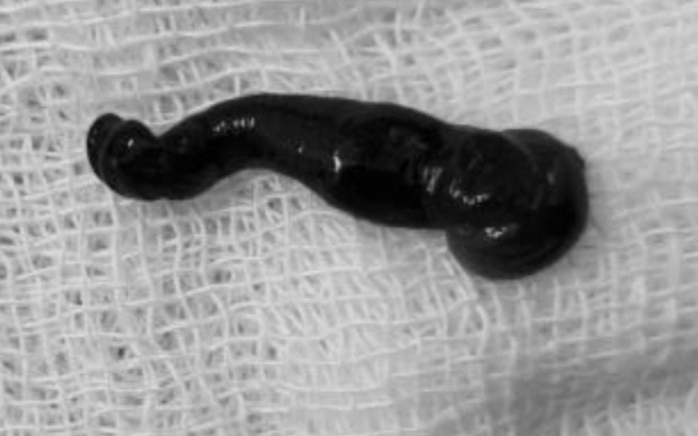 Hãi hùng con đỉa 6cm sống trong mũi cụ bà suốt 3 tuần- Ảnh 2. Khàn tiếng, vướng cổ người đàn ông bất ngờ được phát hiện con đỉa dài 6cm trong cổ họng