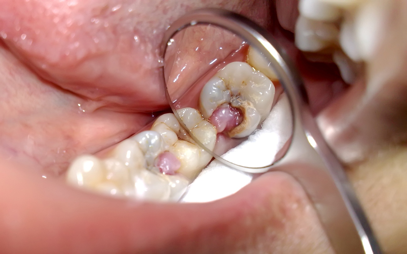 Chớ chủ quan với cơn đau răng