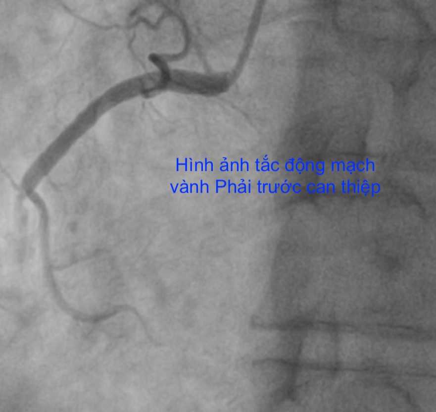 28 Tết, bác sĩ xuyên đêm cứu sống liên tiếp 5 ca nhồi máu cơ tim và nhồi máu não- Ảnh 1.