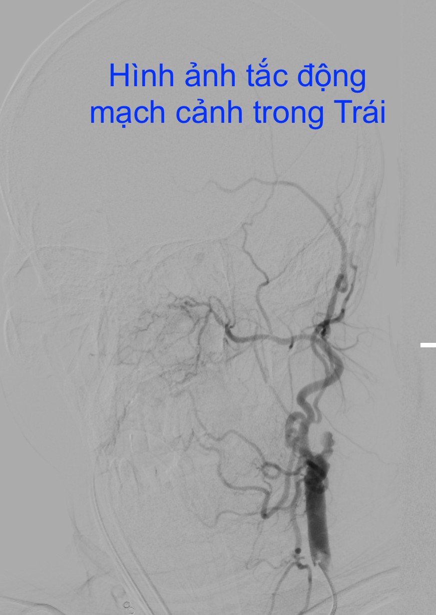 28 Tết, bác sĩ xuyên đêm cứu sống liên tiếp 5 ca nhồi máu cơ tim và nhồi máu não- Ảnh 4.