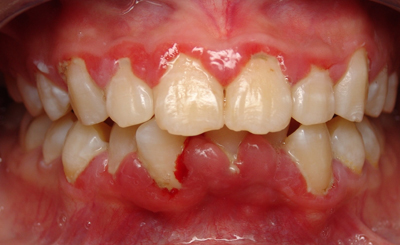 5 cách phòng viêm quanh răng tránh nguy cơ rụng răng- Ảnh 1.