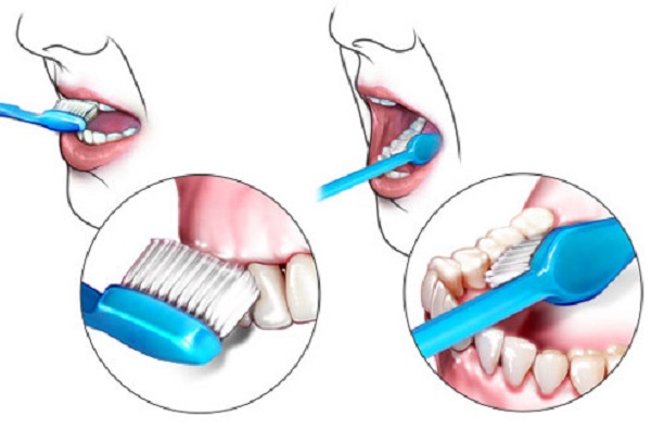 5 cách phòng viêm quanh răng tránh nguy cơ rụng răng- Ảnh 2.