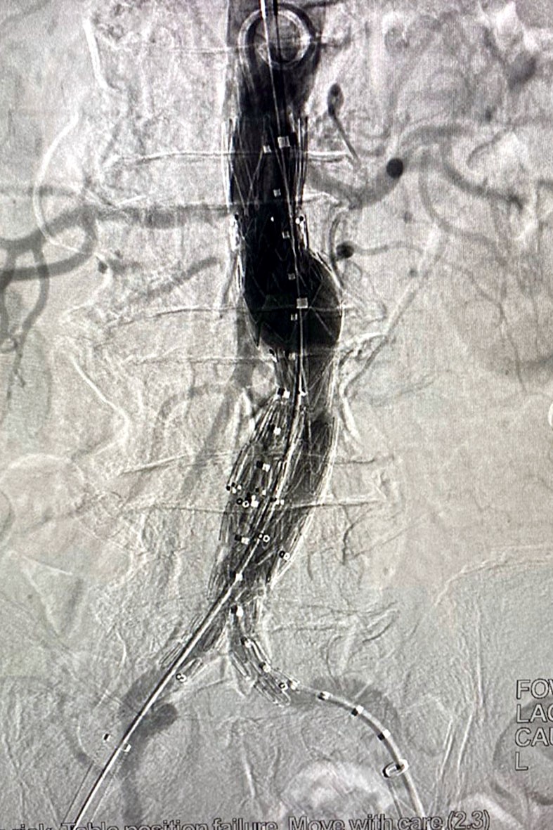 Bệnh viện Hữu nghị Đa khoa Nghệ An triển khai thường quy kỹ thuật đặt Stent Graft- Ảnh 4.