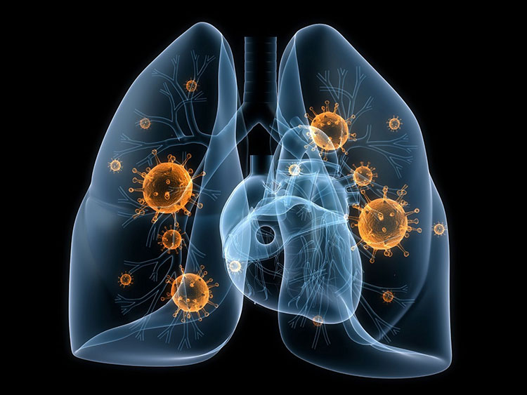 Viêm phổi do Adenovirus ở trẻ: Nhận biết sớm dấu hiệu nguy hiểm- Ảnh 2.