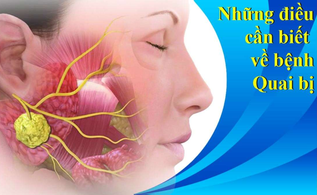 Quai bị: Nguyên nhân, lây truyền, triệu chứng và điều trị- Ảnh 2.