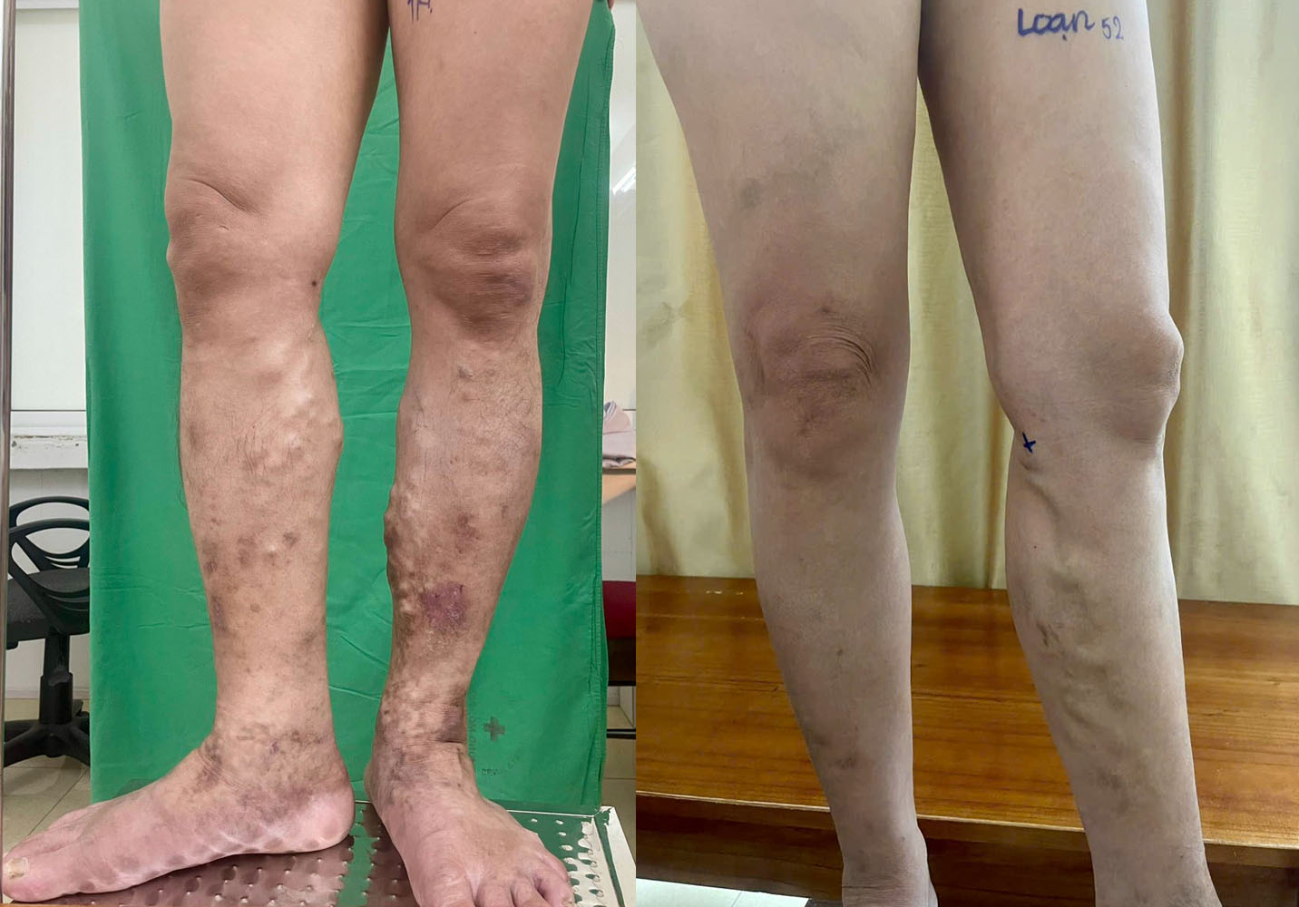 Suy giãn tĩnh mạch: Nguyên nhân, triệu chứng, cách điều trị và phòng bệnh