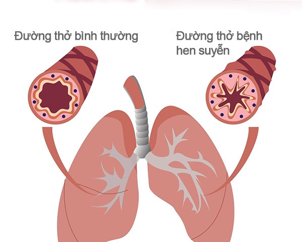 Cách phòng ngừa bệnh hen suyễn và bác sĩ chữa hen giỏi Hà Nội - Bệnh Viện  Đa Khoa Quốc Tế Bắc Hà