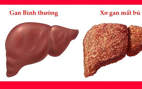 Xơ gan mất bù nguy hiểm như thế nào?