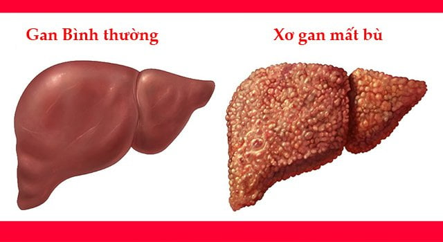 Xơ gan mất bù nguy hiểm như thế nào? - Ảnh 1.