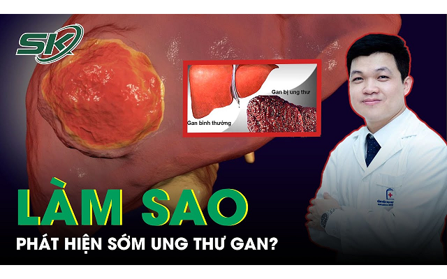 Làm sao để phát hiện sớm ung thư gan?