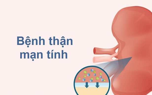 4 cách ngăn chặn bệnh thận mạn tiến triển thành suy thận