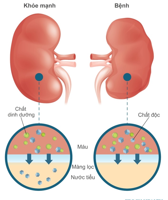 4 cách ngăn chặn bệnh thận mạn tiến triển thành suy thận- Ảnh 2.