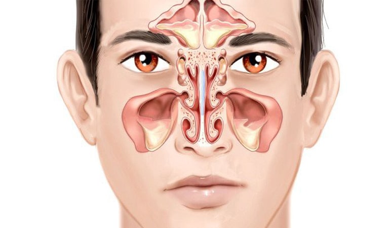 Bệnh viêm đa xoang có nguy hiểm không?- Ảnh 2. Bệnh viêm đa xoang có nguy hiểm không?- Ảnh 2.