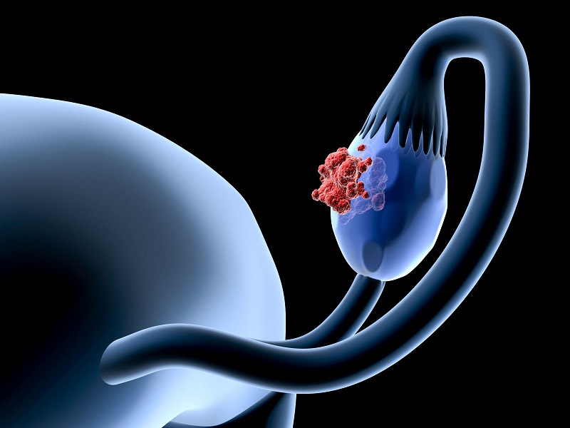 7 biểu hiện sớm của ung thư buồng trứng ở phụ nữ- Ảnh 2.