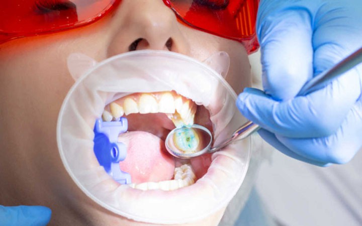 4 cách giúp răng chắc khỏe, ngừa sâu răng