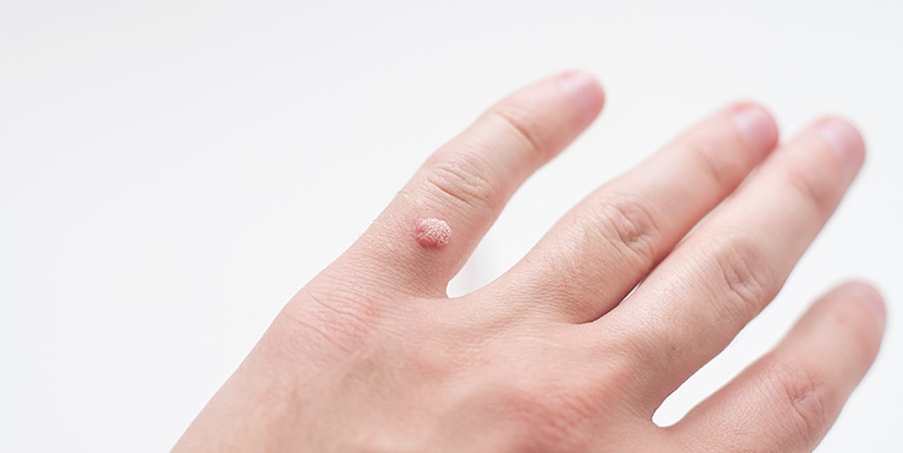 wart on a finger on a white background | CMC | Cosmetic Medical Clinic
