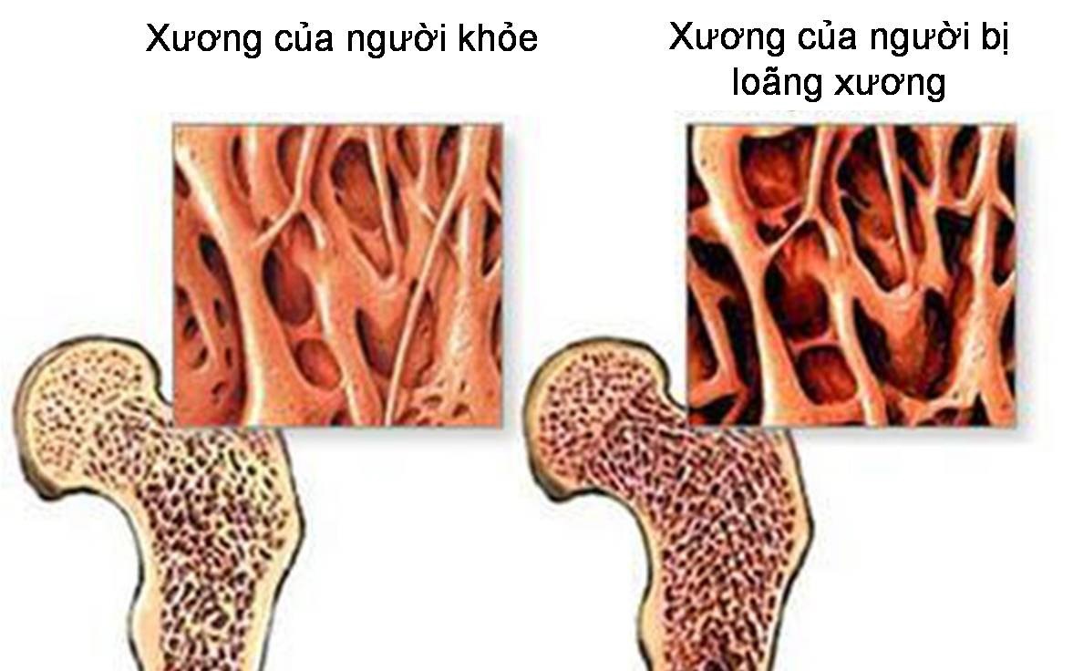 Xoa bóp bấm huyệt có lợi ích gì với người loãng xương?