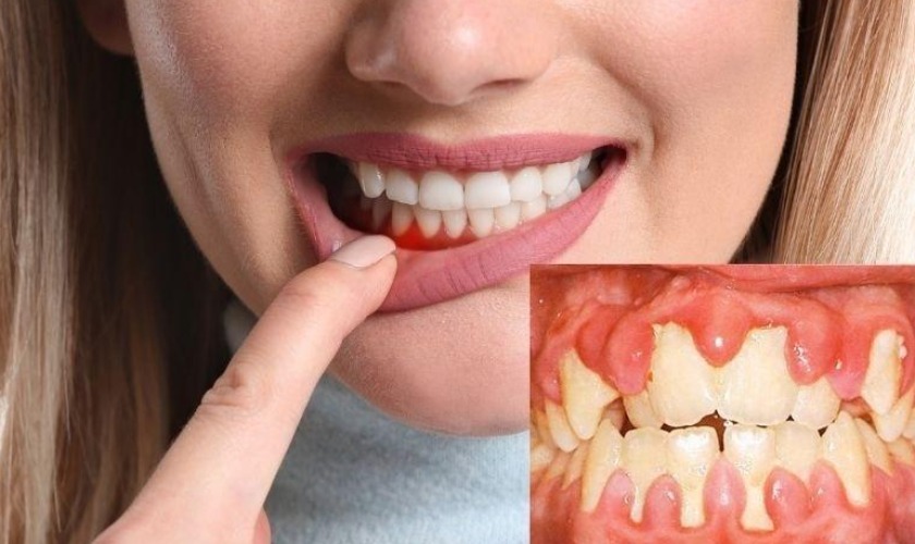 Viêm nướu răng bao lâu thì khỏi? Cách điều trị hiệu quả