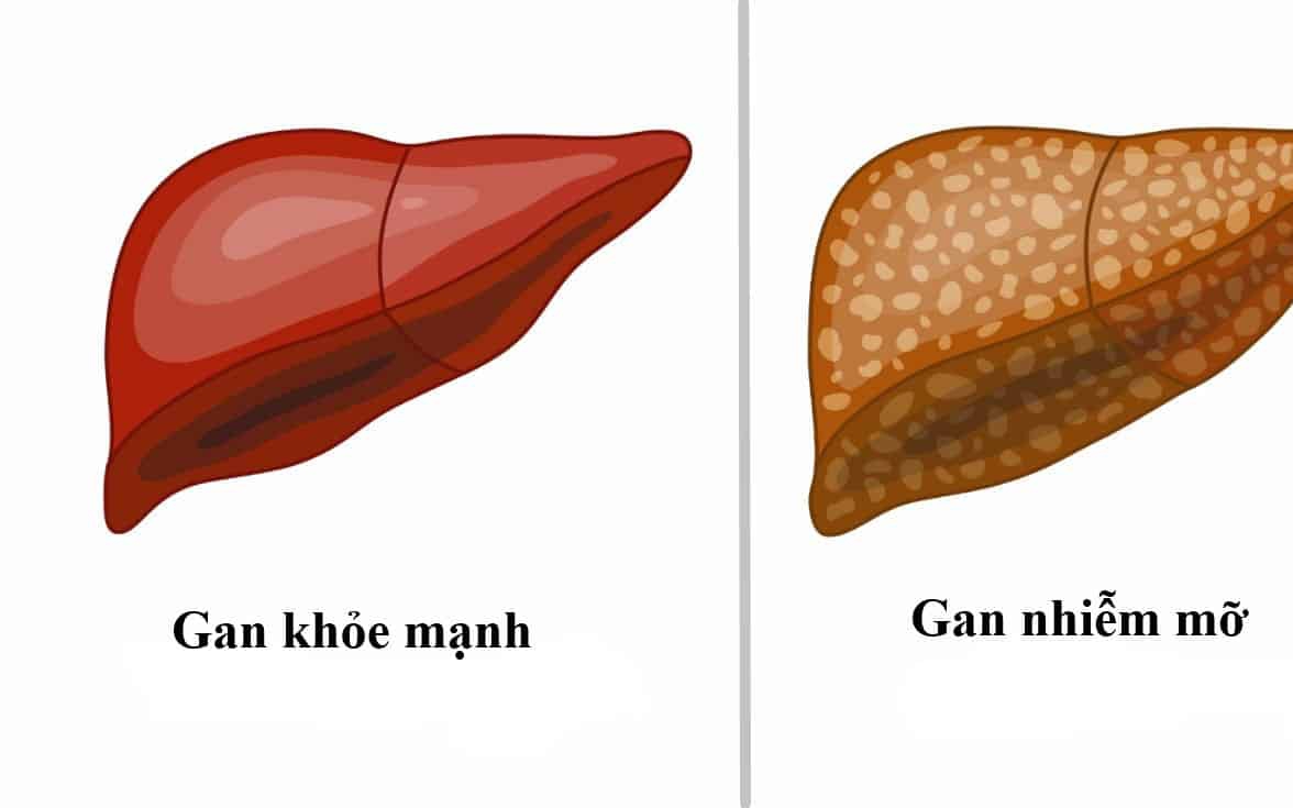 Gan nhiễm mỡ: Nguyên nhân, biểu hiện, điều trị và phòng bệnh