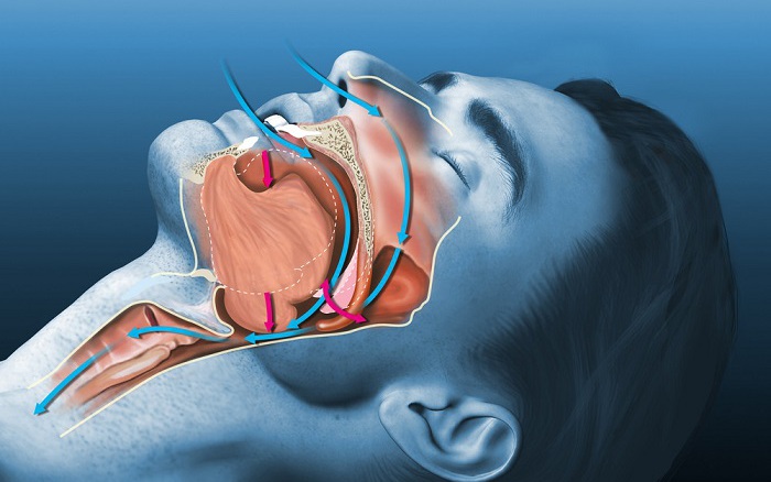 Ngừng thở khi ngủ: Nguyên nhân, biểu hiện, điều trị và phòng bệnh