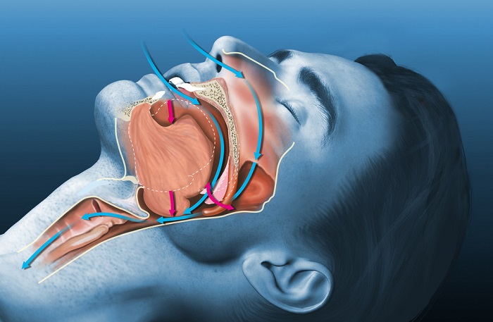 Ngừng thở khi ngủ: Nguyên nhân, biểu hiện, điều trị và phòng bệnh- Ảnh 2.
