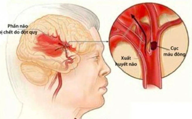 Nhận biết và xử trí chấn thương sọ não- Ảnh 1. Nhận biết và xử trí chấn thương sọ não- Ảnh 1.