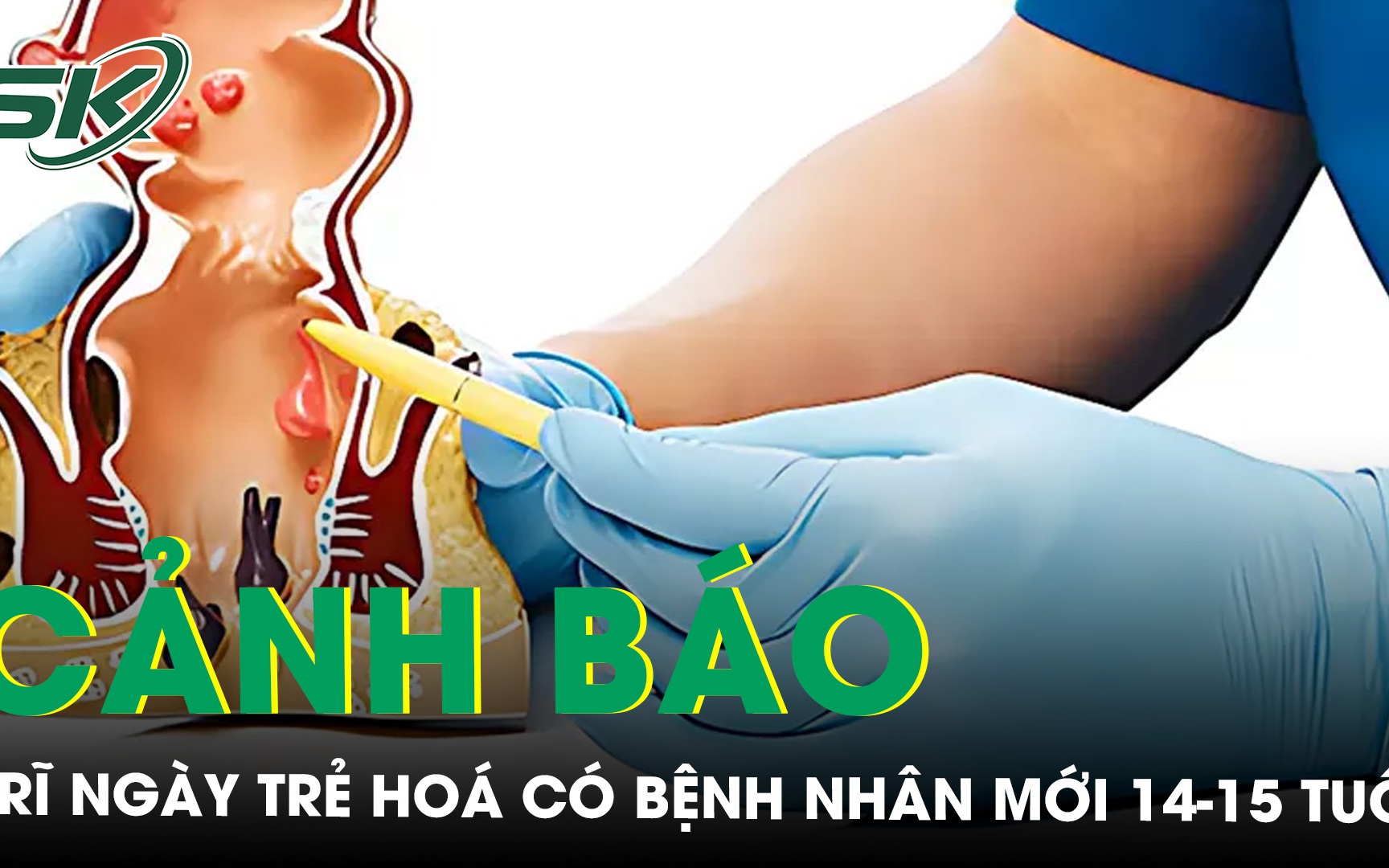 Bệnh trĩ ngày càng trẻ hoá, có bệnh nhân mới 14-15 tuổi