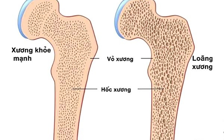 Thói quen tốt giúp phòng ngừa loãng xương sau mãn kinh- Ảnh 3.