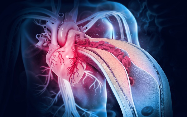 Nhồi máu cơ tim cấp: Nguyên nhân, biểu hiện, điều trị và phòng bệnh