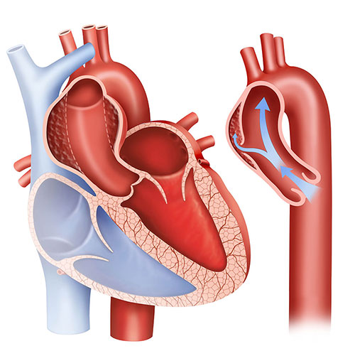Phình động mạch chủ: Nguyên nhân, triệu chứng, điều trị và cách phòng ngừa- Ảnh 2.