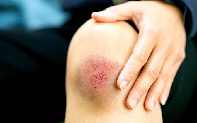 Chỉ một vết xước nhỏ khi đá bóng bị nhiễm tụ cầu vàng khiến không duỗi được chân