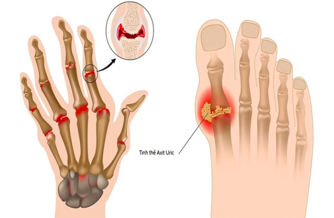 5 cách đào thải axit uric nhanh khỏi cơ thể cần biết- Ảnh 1.