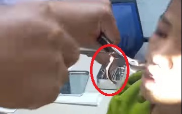 Video bác sĩ gắp con vắt dài 8cm trong mũi bé trai sau khi uống nước ở khe suối