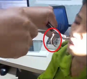 Video bác sĩ gắp con vắt dài 8cm trong mũi bé trai sau khi uống nước ở khe suối- Ảnh 2.