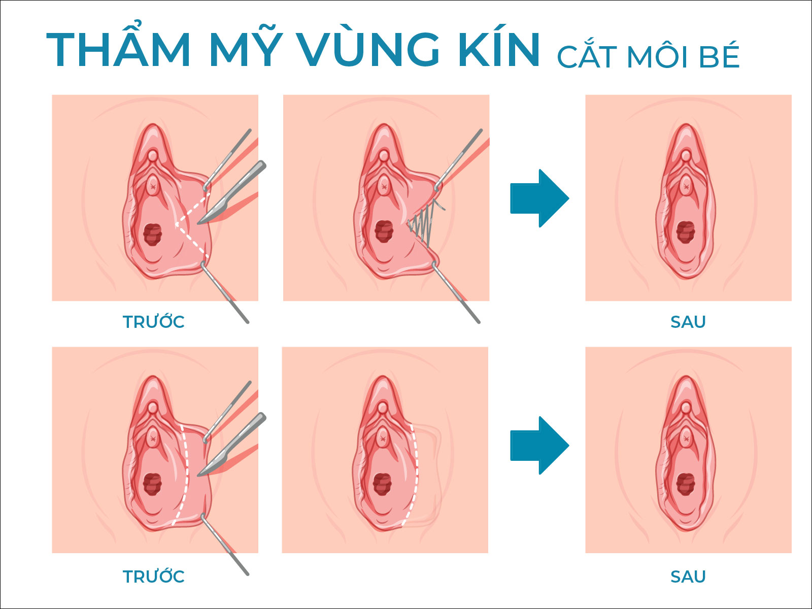Trẻ hoá vùng kín bằng phẫu thuật: Thu hẹp âm đạo và tạo hình môi bé