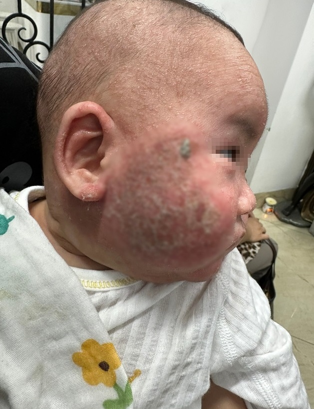 Chữa viêm da cơ địa bằng tắm lá, bé 5 tháng tuổi phải nhập viện- Ảnh 1.