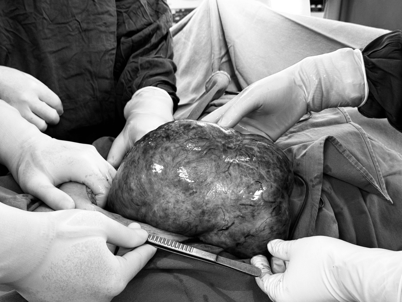 Từ chối phẫu thuật sớm, nữ bệnh nhân khi nhập viện đã suy kiệt, bác sĩ 'lấy ra' khối u buồng trứng nặng 3kg- Ảnh 2.