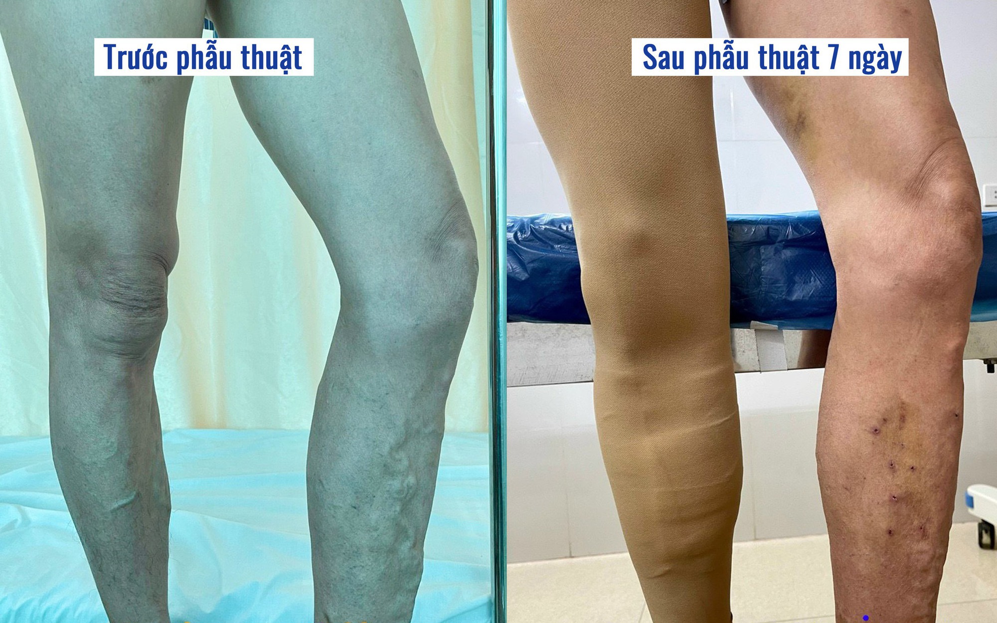 Tĩnh mạch chi dưới có thể gây ra những biến chứng nguy hiểm gì?
