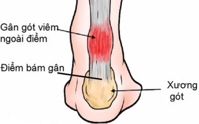 Các dấu hiệu cảnh báo cần dừng ngay chơi thể thao- Ảnh 4. Cách phòng ngừa tổn thương gân lớn nhất trong cơ thể khi chơi thể thao