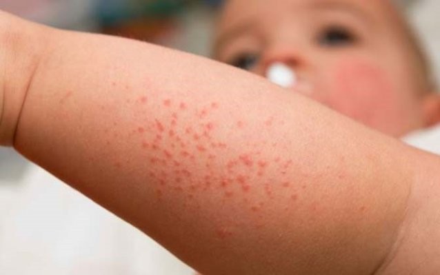 Các câu hỏi thường gặp liên quan đến sốt phát ban