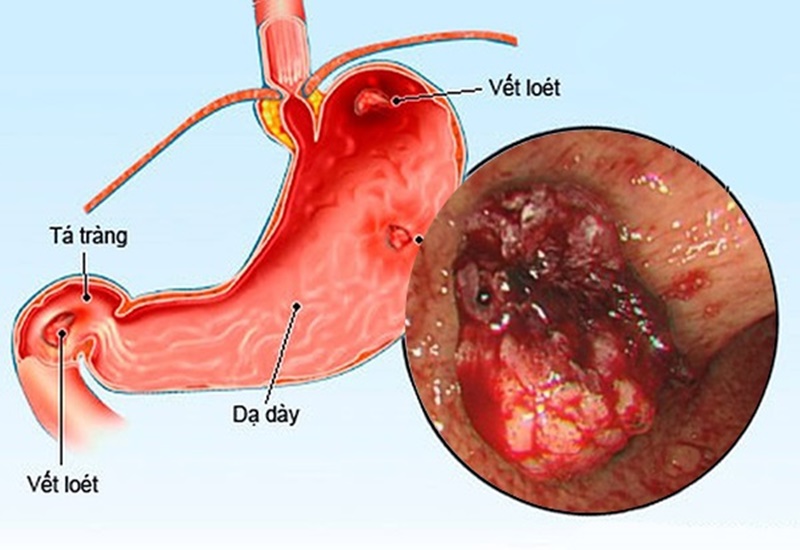 Triệu chứng viêm loét dạ dày và cách điều trị bệnh