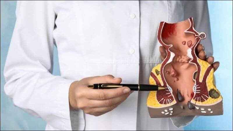 Trĩ xuất huyết: Đừng chủ quan với nguy cơ mất máu nghiêm trọng- Ảnh 2.