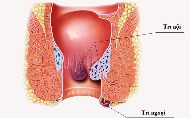 Bài tập giảm tái phát cho người bệnh trĩ